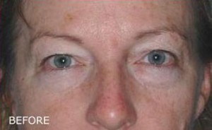 Eyelid Surgery
