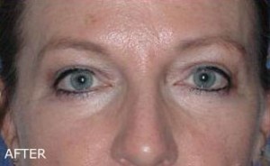 Eyelid Surgery