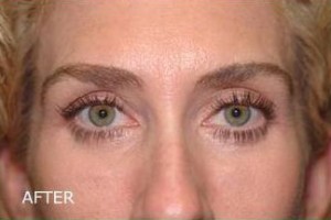 Eyelid Surgery