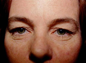 Eyelid Surgery