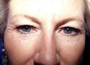 Eyelid Surgery
