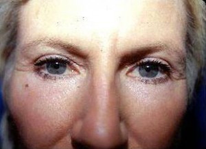 Eyelid Surgery