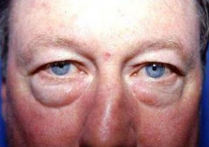 Eyelid Surgery