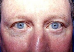 Eyelid Surgery
