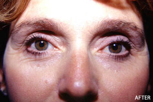 Eyelid Surgery