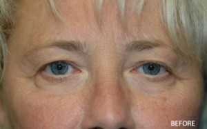 Eyelid Surgery
