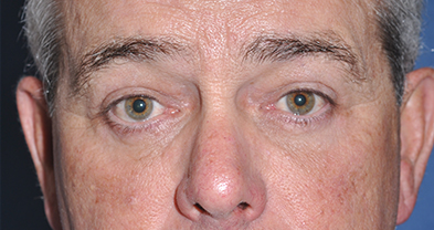 Eyelid Surgery