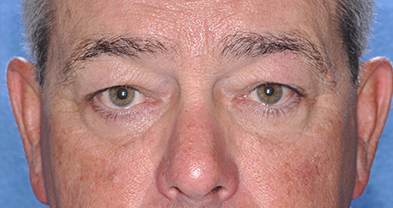 Eyelid Surgery