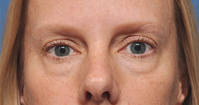 Eyelid Surgery