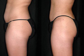 Liposuction