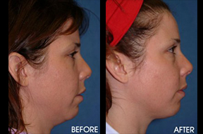 Liposuction