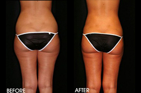 Liposuction