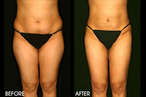 Liposuction