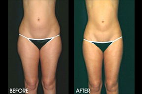 Liposuction