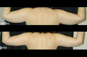Liposuction
