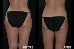 Liposuction