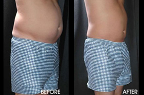 Liposuction