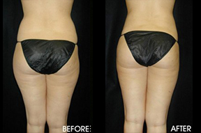 Liposuction