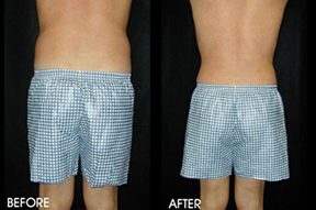 Liposuction