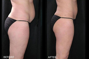Liposuction