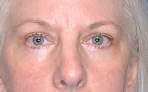 Eyelid Surgery