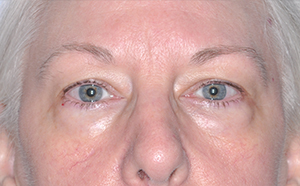 Eyelid Surgery