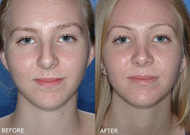 , Rhinoplasty Before and After Photos