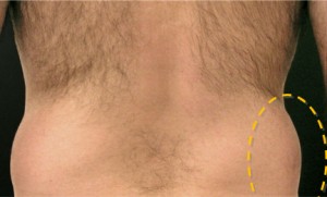 CoolSculpting