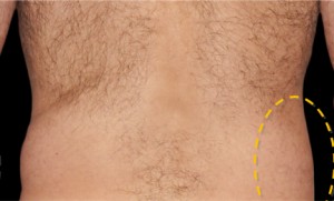 CoolSculpting