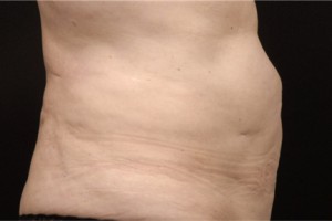 CoolSculpting