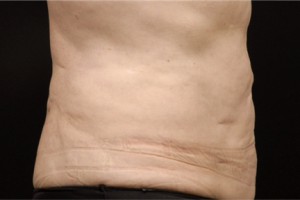 CoolSculpting
