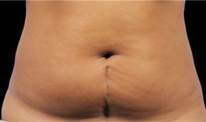CoolSculpting