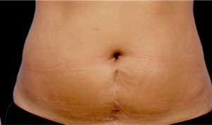 CoolSculpting