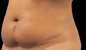 CoolSculpting