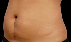 CoolSculpting