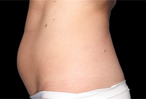 CoolSculpting