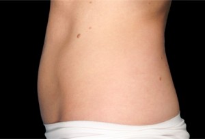 CoolSculpting