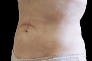 CoolSculpting