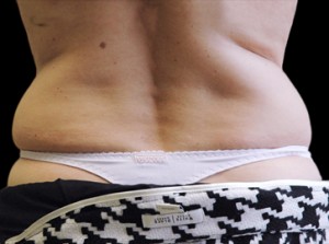 CoolSculpting