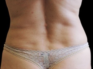 CoolSculpting