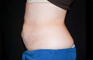 CoolSculpting