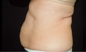 CoolSculpting