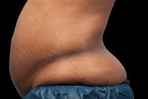 CoolSculpting