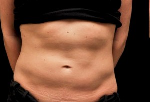 CoolSculpting