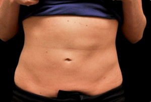CoolSculpting