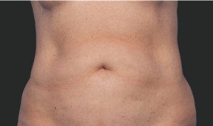 CoolSculpting