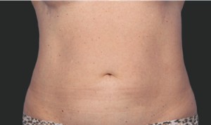 CoolSculpting