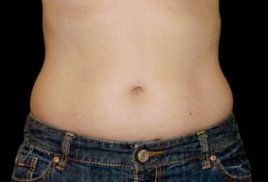 CoolSculpting