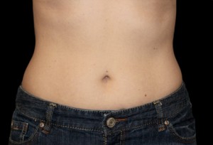 CoolSculpting