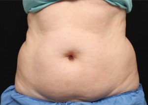 CoolSculpting